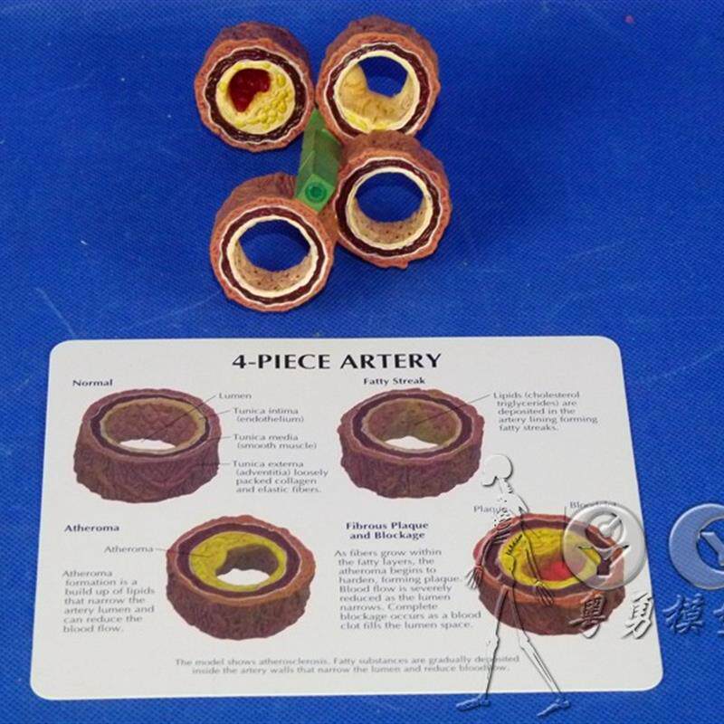 人体血管模型血k栓模型血管硬化血管梗塞病态血管人体模型