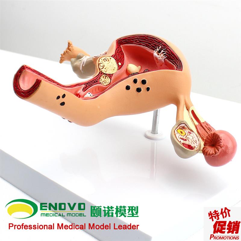 颐诺正品人体子宫卵巢阴t道疾病模型生殖科妇科医用医患模型