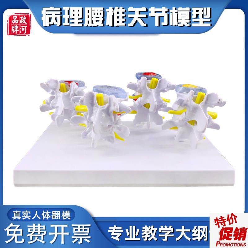 政河病理腰椎模型四分型正u常病变脊椎骨骼椎间盘退变骨质突出疏,玩具/童车/益智/积木/模型,其他模型玩具,淘宝优惠券,粉丝福利购,淘宝优惠卷