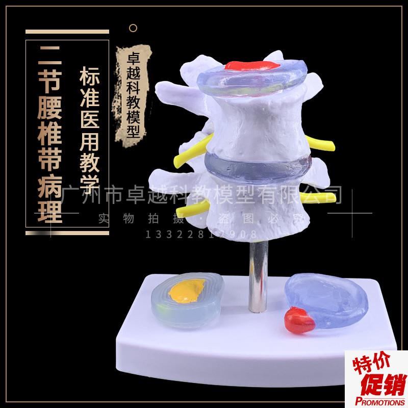 椎间盘脱出d腰脊柱模型脊椎骨骼解剖模型腰椎模型关节模型骨骼