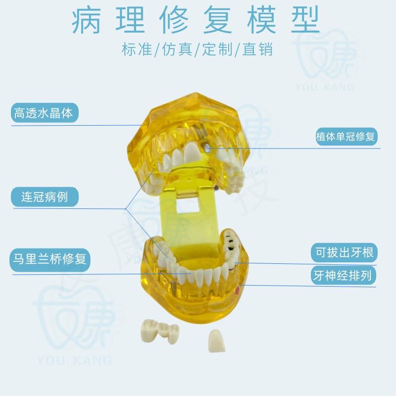 牙齿模型病理修复可拆卸正畸口腔病理牙L模型牙科医患活动沟通