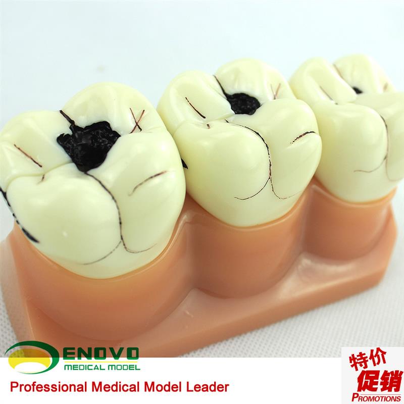 ENOVOd颐诺口腔科牙齿龋齿模型儿童虫牙蛀牙模型口腔健康儿童病理