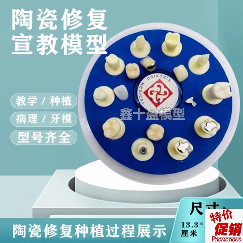 牙齿模型口腔教学陶瓷10*1仿真修复治疗过程种植S根管病理医患沟