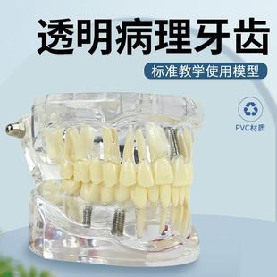 病理牙科口腔教学模型水晶v透明综合成人病牙医患沟通种植钉模型