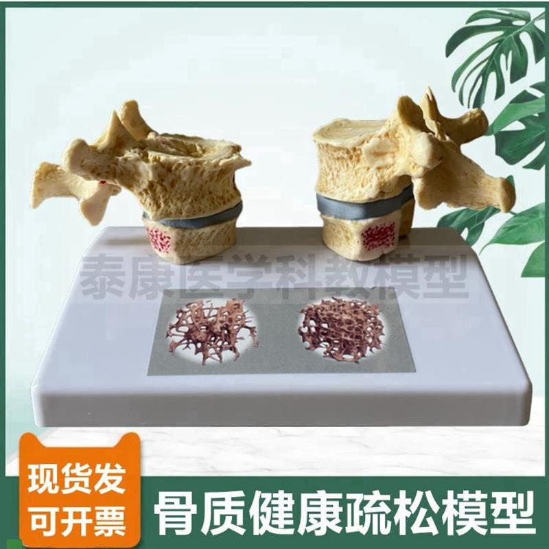 人体骨骼模型脊椎骨质密度疏松老年人骨骼椎间盘T压迫神经演示病