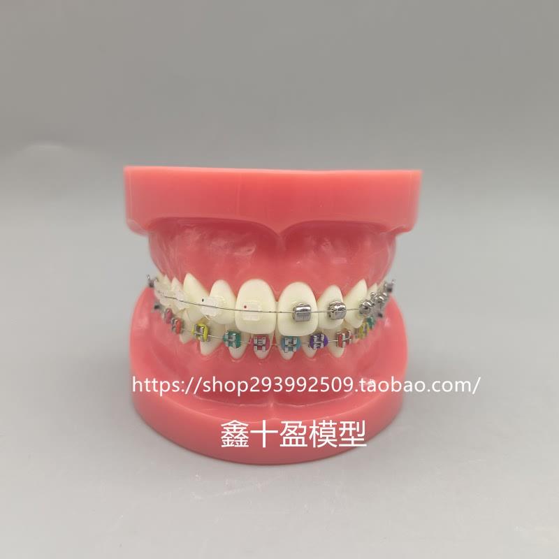 牙科正畸模型球形金属自锁托槽正F畸模型矫正练习模型医患沟通