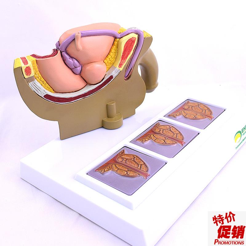ENOVO颐诺人体男性s前列腺模型前列腺增生肥大模型BHP模型