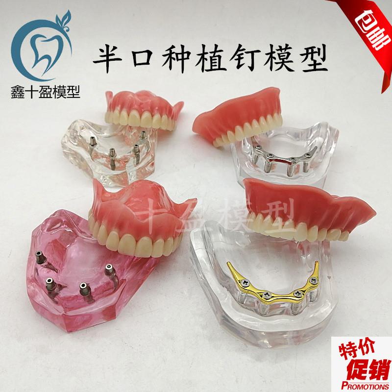 牙科模型医d患沟通2四4颗钉种植与修复模型种植钉球帽杆卡导板