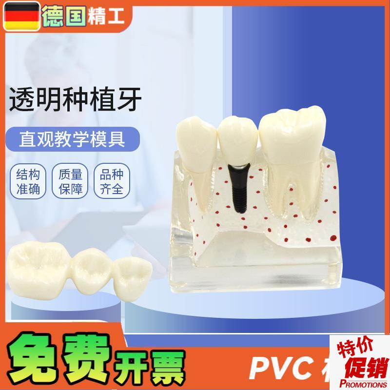 德国】透明种植牙模型牙科w修复模型透明可拆卸病理种植体牙
