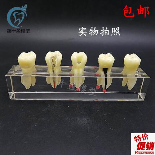 口腔教学模具g水晶根管治疗模型可拆修复牙冠龋齿蛀牙病理M4012