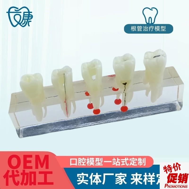 根管牙髓治疗模型k牙科口腔教学牙模种植修复病理模型医患沟通模