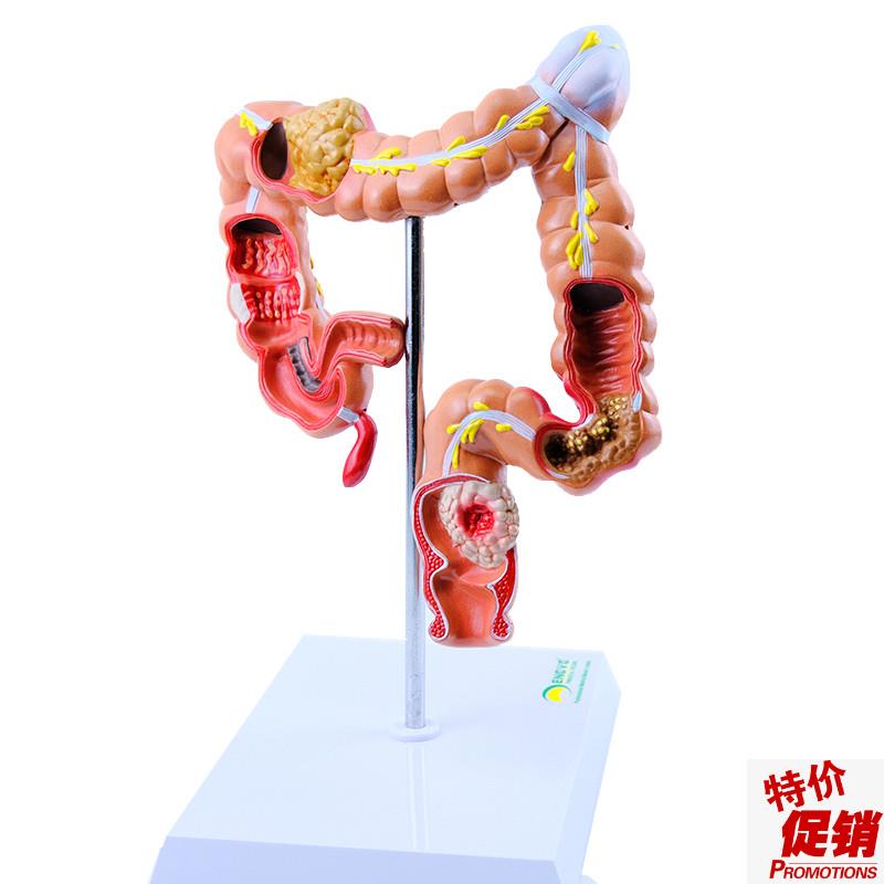 ENOVO颐诺人体大肠疾病展示模型结肠直肠道病变症状X消化系统疾病