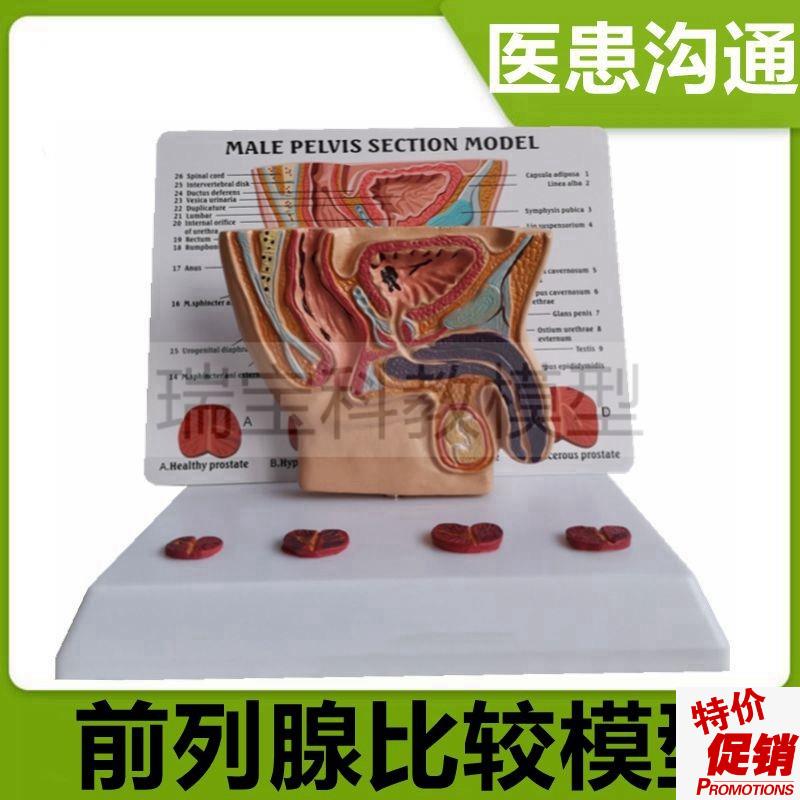 男盆腔模型泌尿生殖器官前列腺膀胱尿道变化狭窄老年X人男科医患