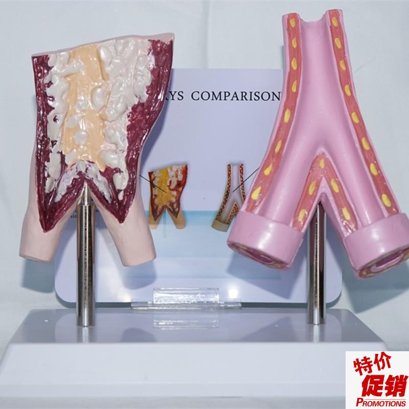 吸烟血管与正g常血管比较模型人体医用教学健康保健讲解展示