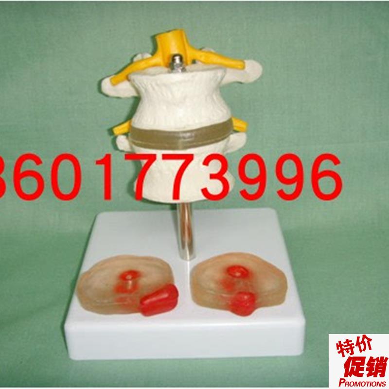 2节腰椎附2个病变椎间s盘模型腰椎模型2节腰椎带腰间盘病变模型