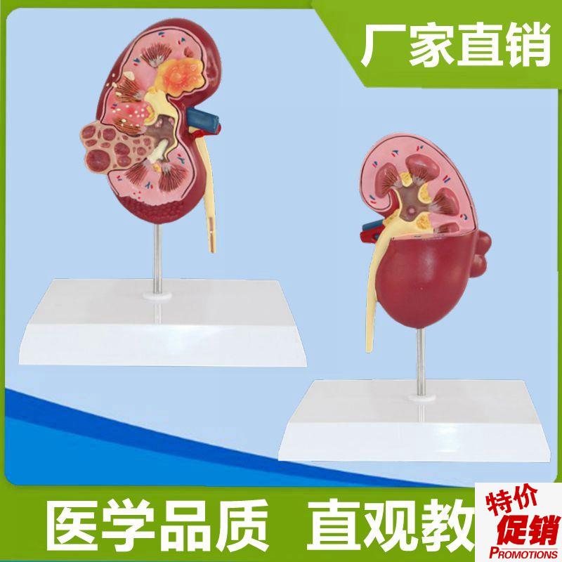 病理肾脏临床常见医患泌尿v系统内脏医药礼品科普展示健康宣传人