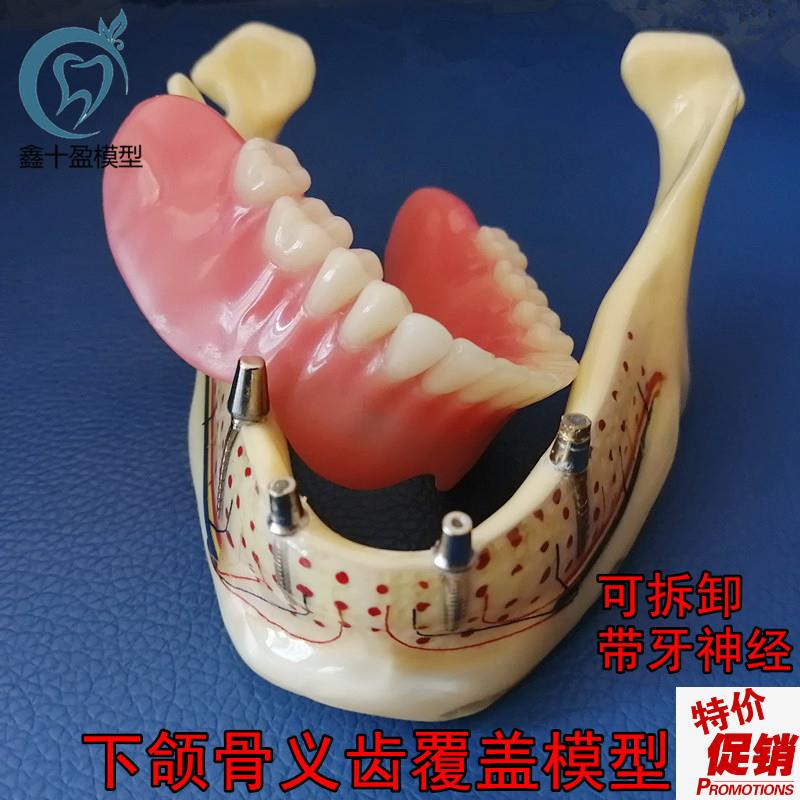 牙科口腔下颌骨展示模型透明下颌骨展示种J植钉义齿修复模型6005