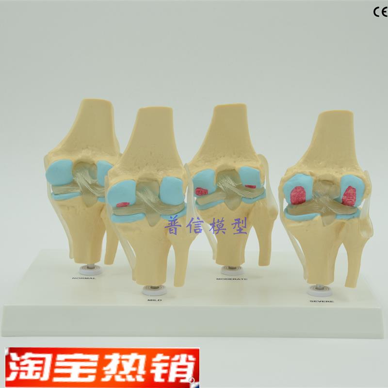 普信四分型膝关节正常膝盖骨病变组E合模型骨架模型骨科医药教学