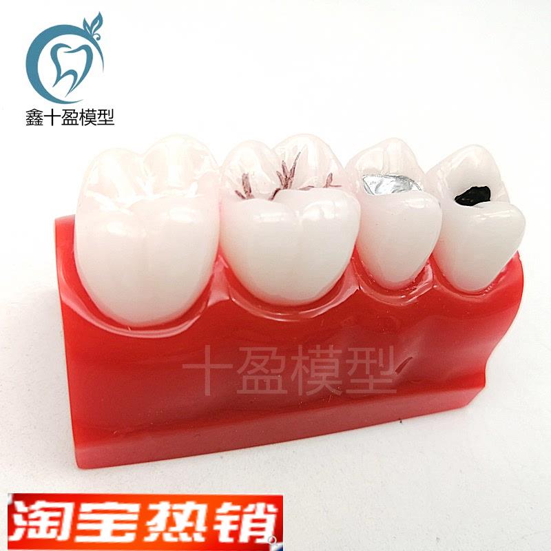 牙科口腔窝沟封闭展示医患教w学模型儿童防蛀龋坏牙齿模型M10