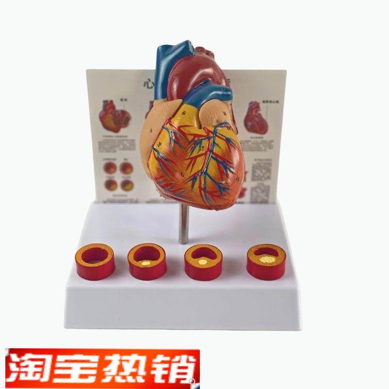 康泰模型心血管粥样硬化狭窄阻塞病D理冠状动脉临床医药促销人体
