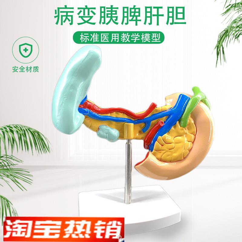 病变胰脾肝胆十二指肠模型病理标本D胰脾肝胆人体器官解剖教学模