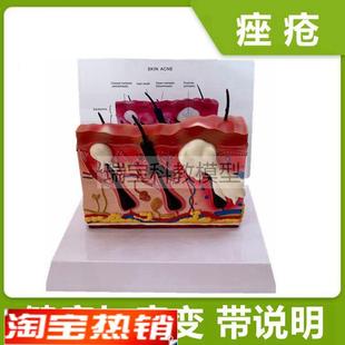 痤疮皮肤模型病理面部皮肤结构z毛囊人体皮肤解剖医美整形医用教