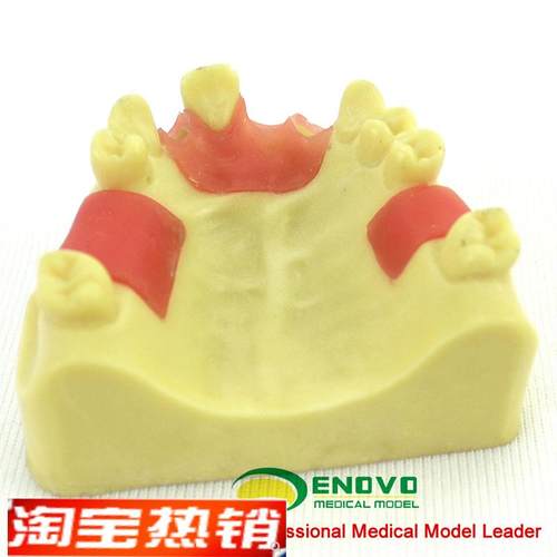 ENOVO颐诺上颌m缺失种植实训模型口腔即刻种植操作上颌骨缺失牙齿