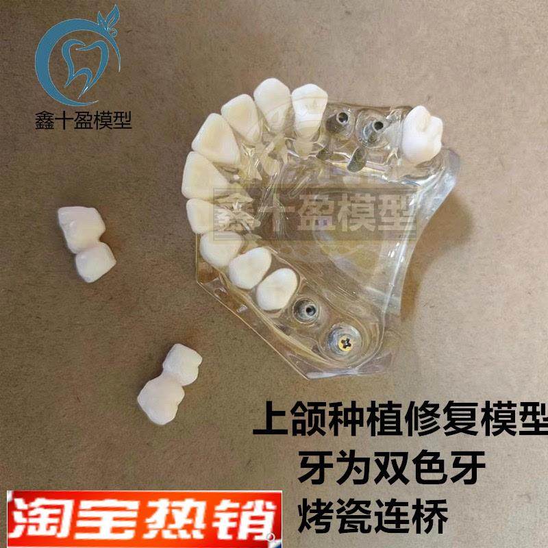牙科种植模型2011上t颌种植解说义齿修复烤瓷连桥种植钉模型