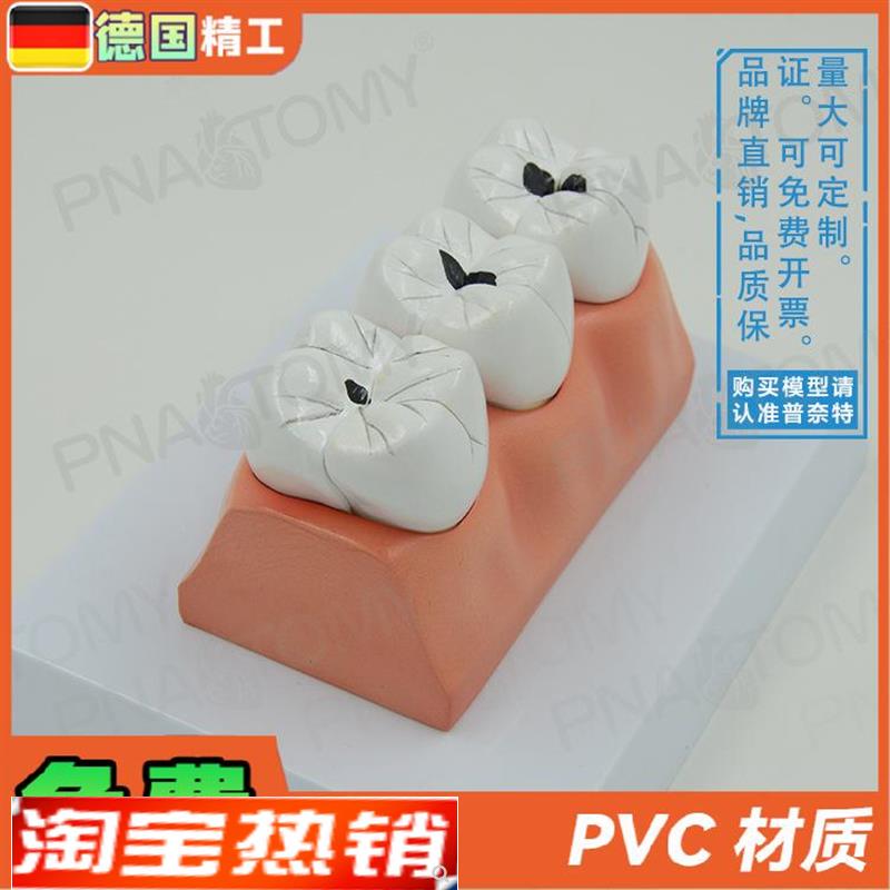 德国】牙a科牙齿龋齿解剖分解模型口腔科牙科病理蛀牙模型教学展