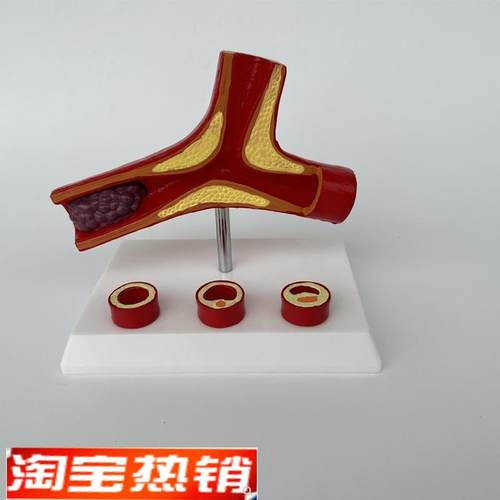 心脑血管堵塞模型关节血栓血液浓度脂肪病理粥R样硬化人体解剖教