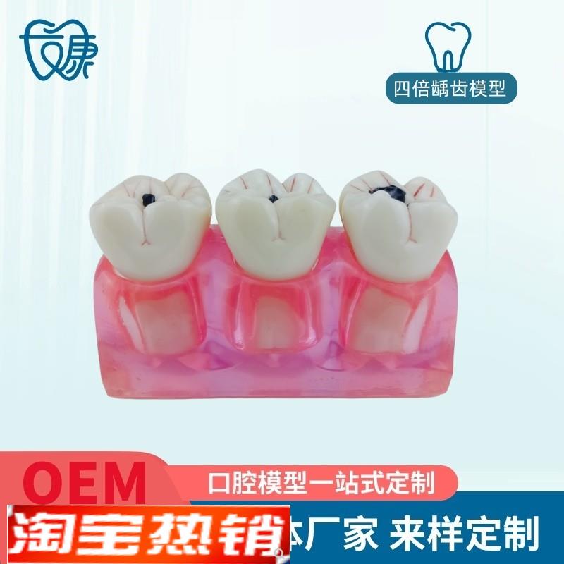 牙模型牙科口腔教学模型窝沟封闭模型K龋齿对比模型龋齿模型