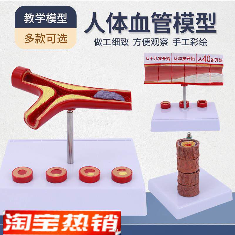 血管/堵塞动支脉粥样/硬化心z血管动脉/硬化模型血管病理模型血栓
