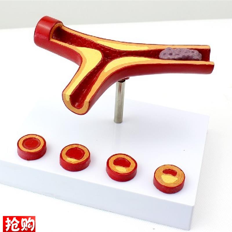 ENOVO颐诺冠状动脉性心血管动脉硬化模型老年心T脏模型血栓心内科