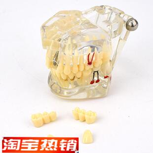 ENOVO颐诺口j腔模型齿科种植阻生齿牙体牙髓口腔教学马里兰桥瓷贴