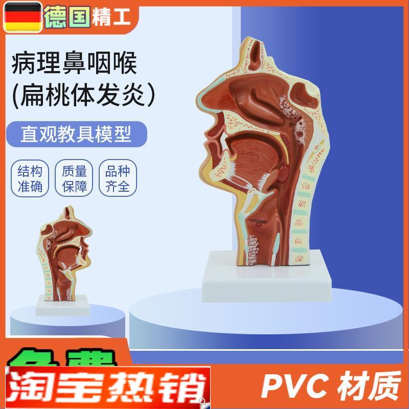 德国】PNT-0736人体鼻腔咽喉解剖教学模型O病理鼻咽喉(扁桃体发