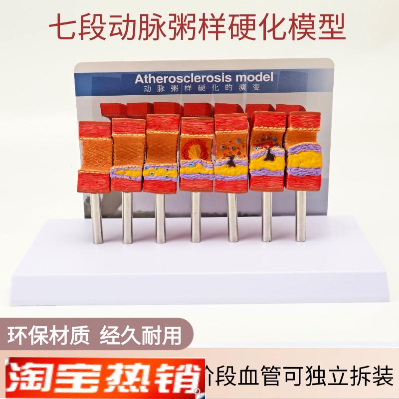 动脉粥样硬化模型血m管血栓栓塞模型动脉血管人体医用医学教学模