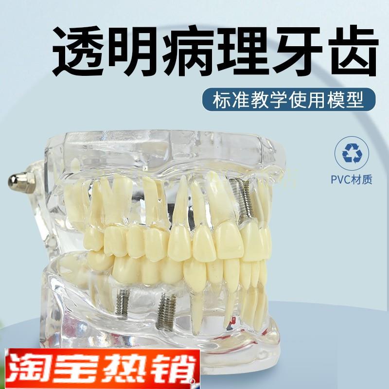 病理口腔模型牙齿模型模具早教刷牙牙模标准教V具牙医讲解模型