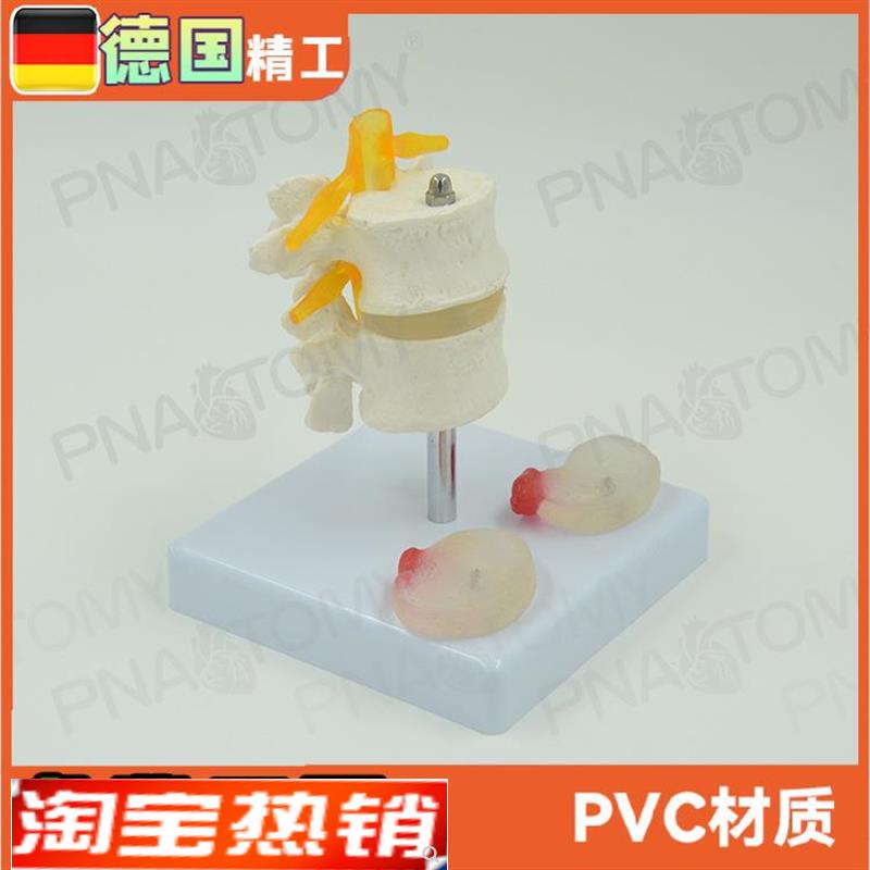 德国】人体腰椎盘突出模型两节腰椎骨骼骨科N推拿演示教学医学模