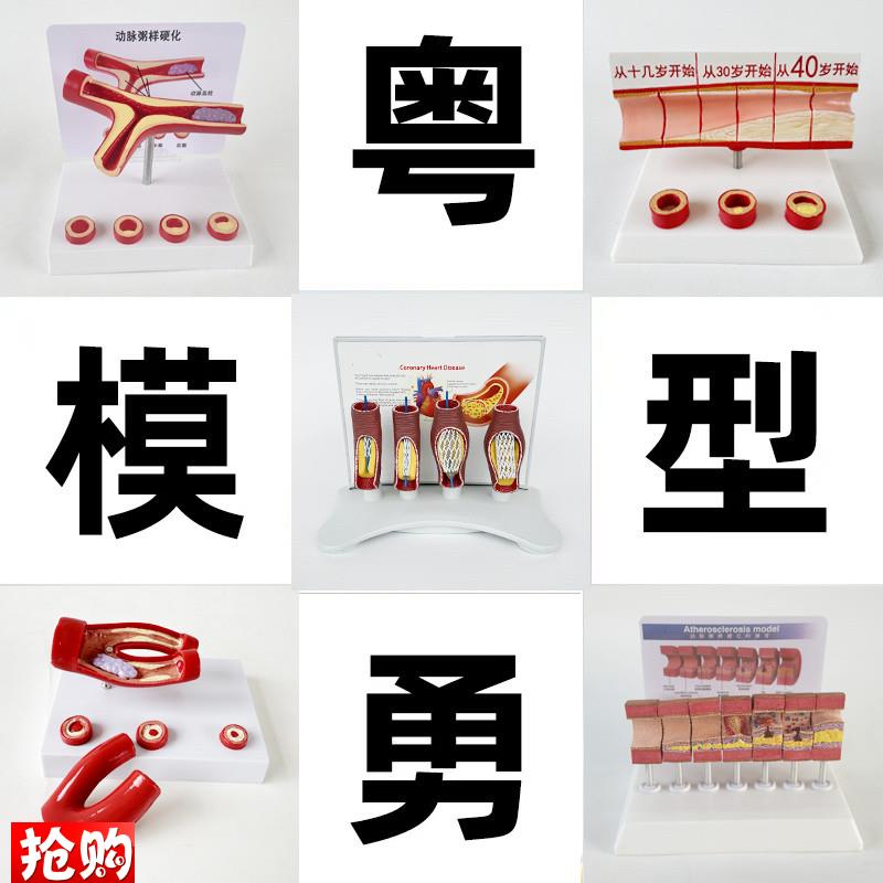 动态血管粘稠堵塞模型动支脉粥样硬化心血管O支架放大病理教学模