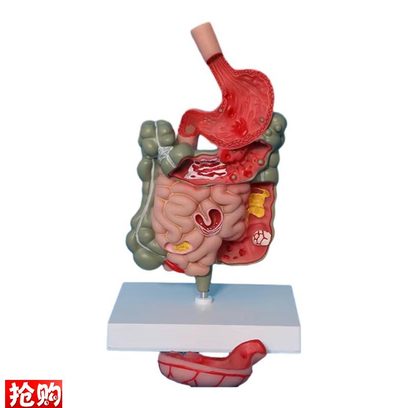 大肠病理模型人体结肠病变模型肠胃G模型大肠病变模型肠道疾病