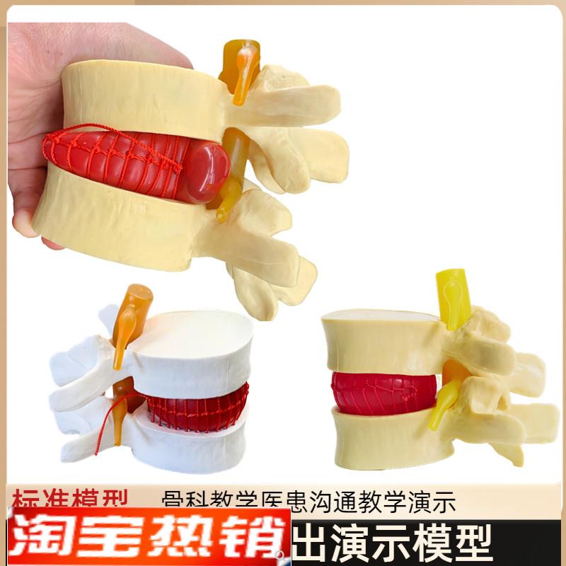 人体脊柱模型脊椎骨头腰椎间盘模具椎体I模型突出受压病理骨质教