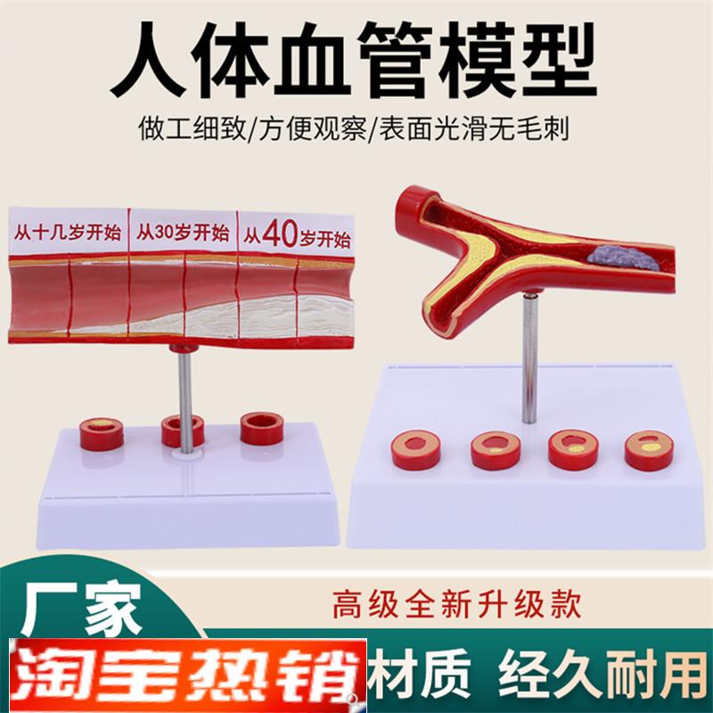 堵塞心血管模型关节血栓血液浓B度脂肪病理粥样硬化人体解剖教具