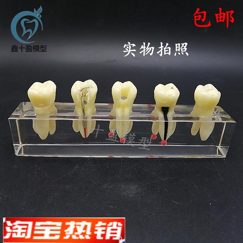 口腔教学模具水晶根管治疗模型可拆修复牙冠龋齿蛀牙病理.M4012
