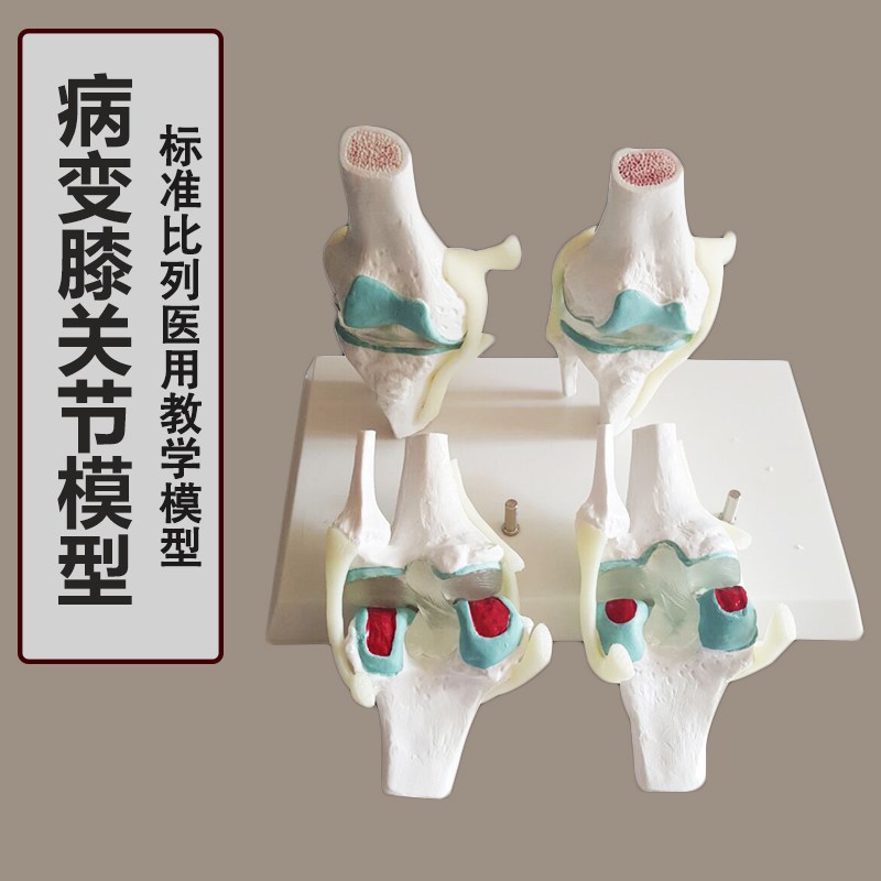 人体病理a膝关节模型病变膝关节退行性膝关节/病关节镜手术