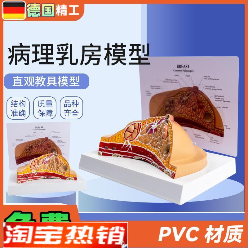 德国】病理乳房模型妇科乳房x解剖模型乳房病理解剖乳房结构模型