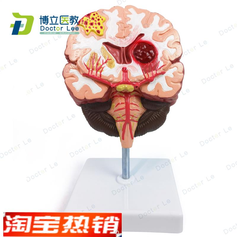 人体脑解剖脑病理疾病脑w病理构造脑(血管)病变脑模型