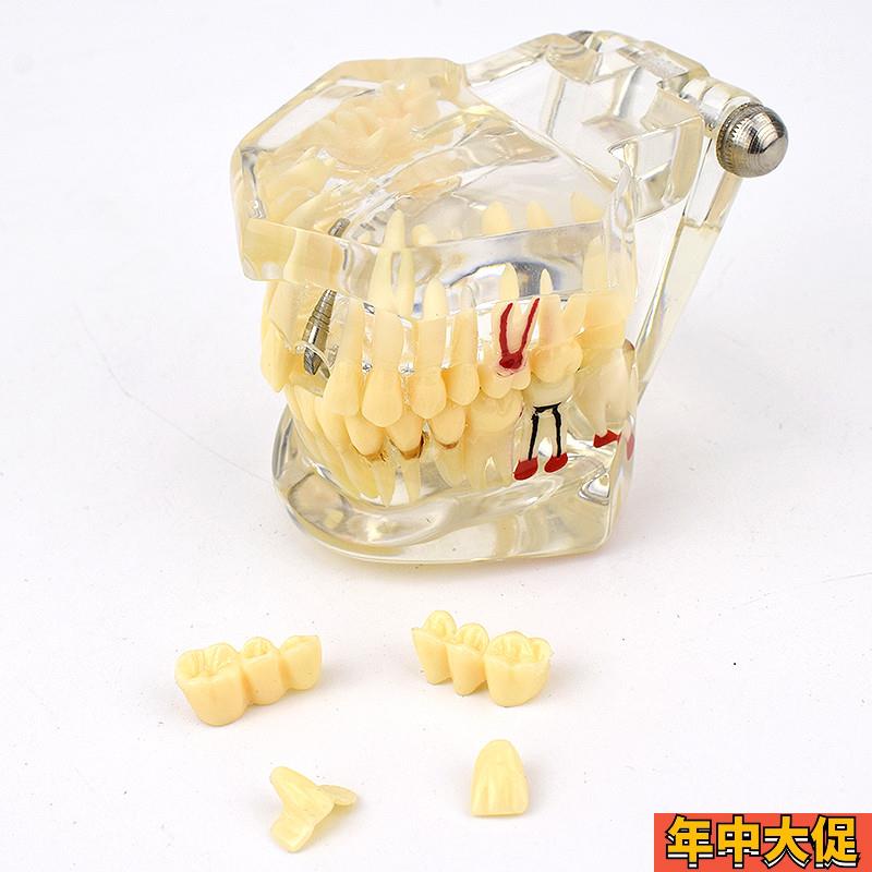 ENOVO颐诺口j腔模型齿科种植阻生齿牙体牙髓口腔教学马里兰桥瓷贴