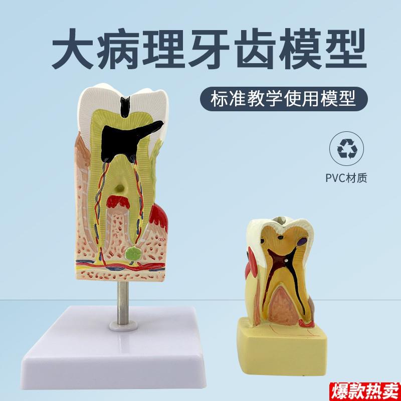 蛀牙模型牙齿V病变四倍牙体综合病理模型牙齿解剖齿科医患沟通