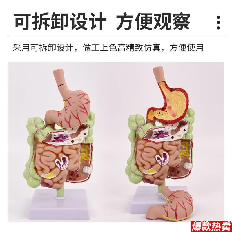 人体大肠病理模型直肠结肠病变解剖g肠胃疾病教学演示医用模型