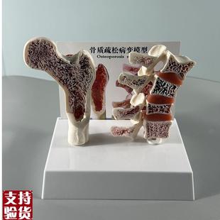 康泰医学教具骨质疏松模型骨密度变化骨折病变人T体骨骼脊柱椎间